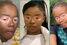 "It's Not Bleaching": Lady With Shiny Circle Around Her Eyes Flaunts Unique Beauty, Video Trends